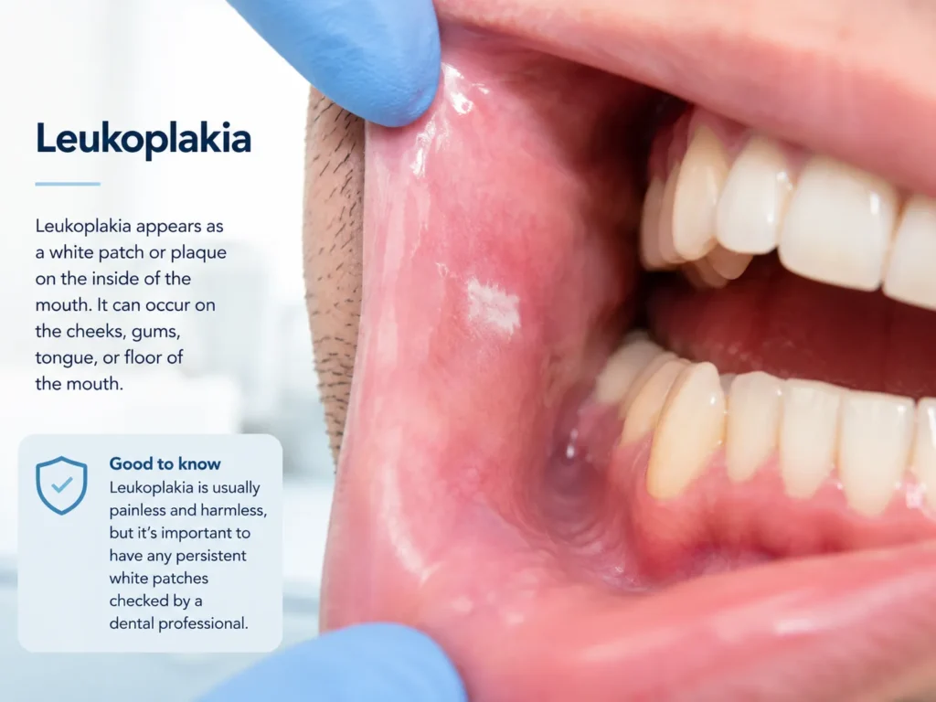 Leukoplakia White Patches in the Mouth converted from png