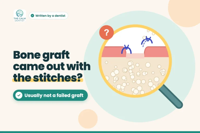 Magnified illustration of a bone graft site with a loose stitch and a few granules, titled Bone graft came out with the stitches? Usually not a failed graft