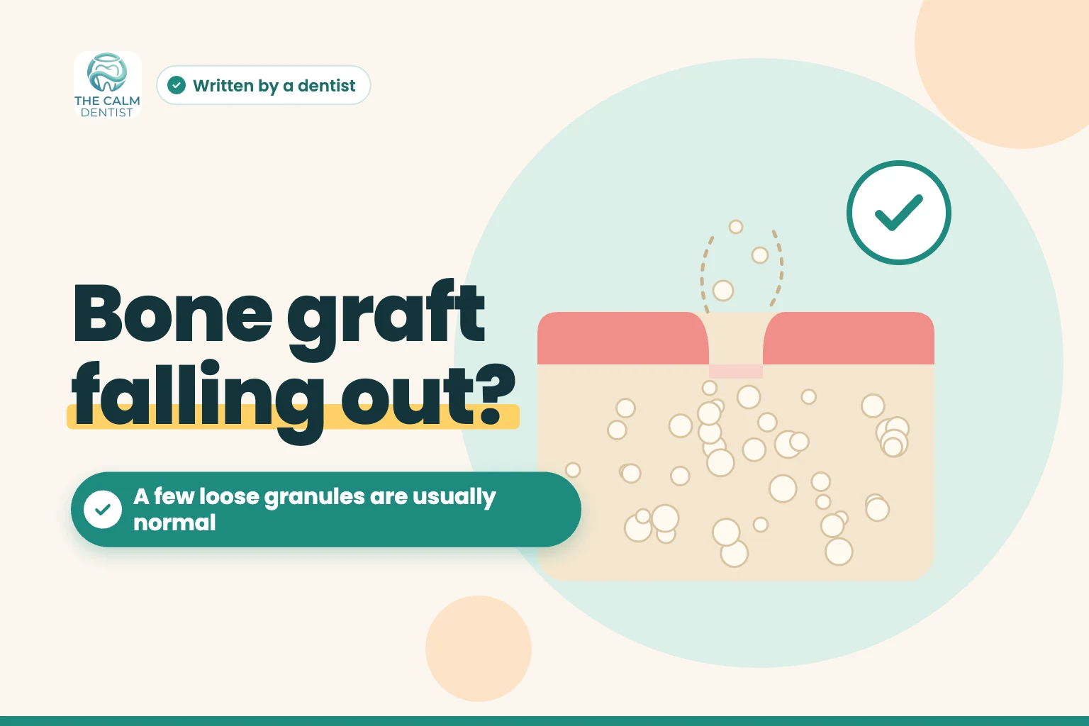 Illustration of a healing bone graft socket with a few granules coming loose, titled Bone graft falling out?
